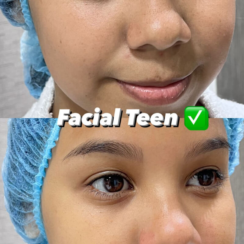 FACIAL TEEN