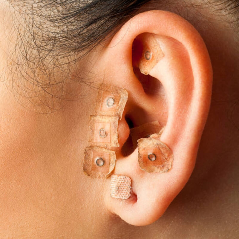 Auriculoterapia: Alivio Natural de Dolencias Mediante Balines en el Oído