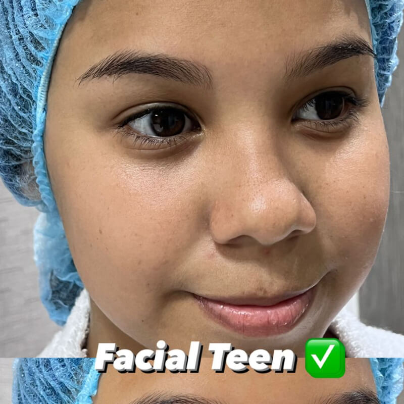 2x1 FACIAL TEEN