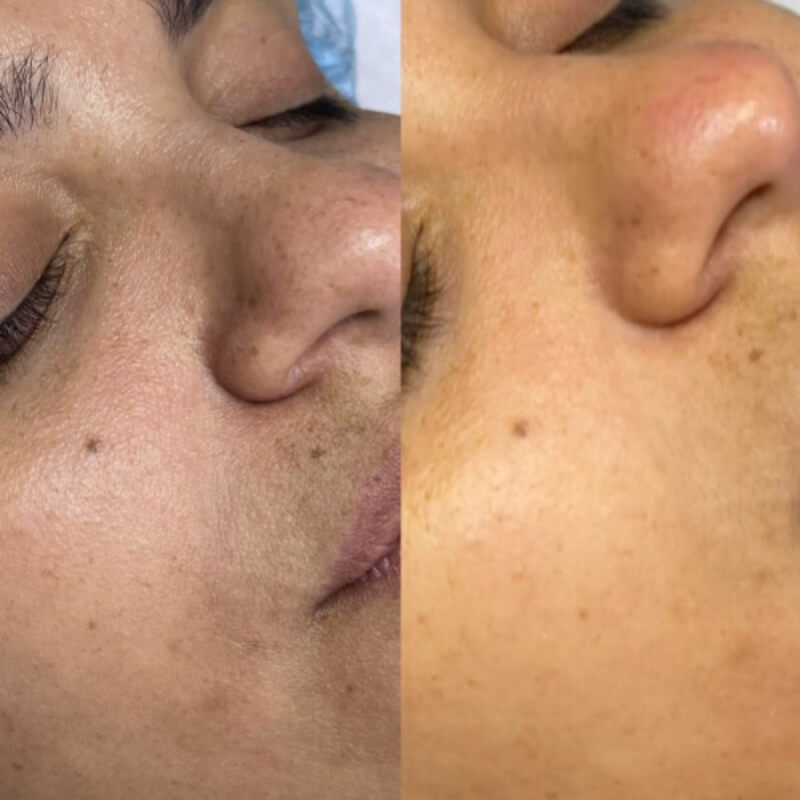 SKIN DETOX